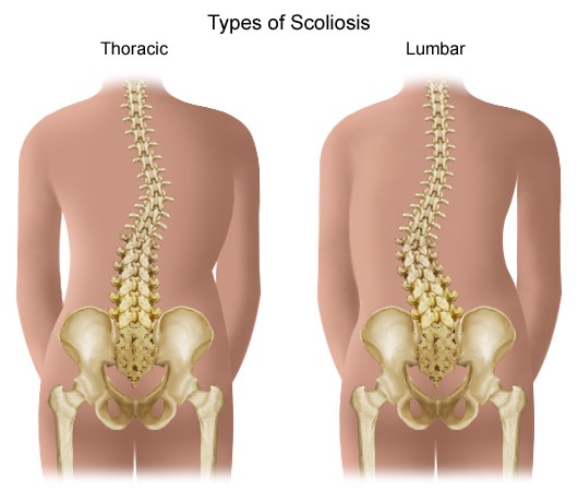 spines with thoracic and lumbar scoliosis
